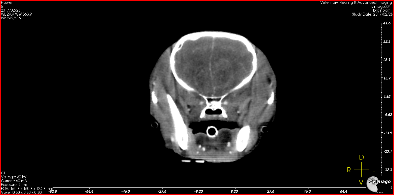 Contrast enhancing forebrain tumor crossing midline
