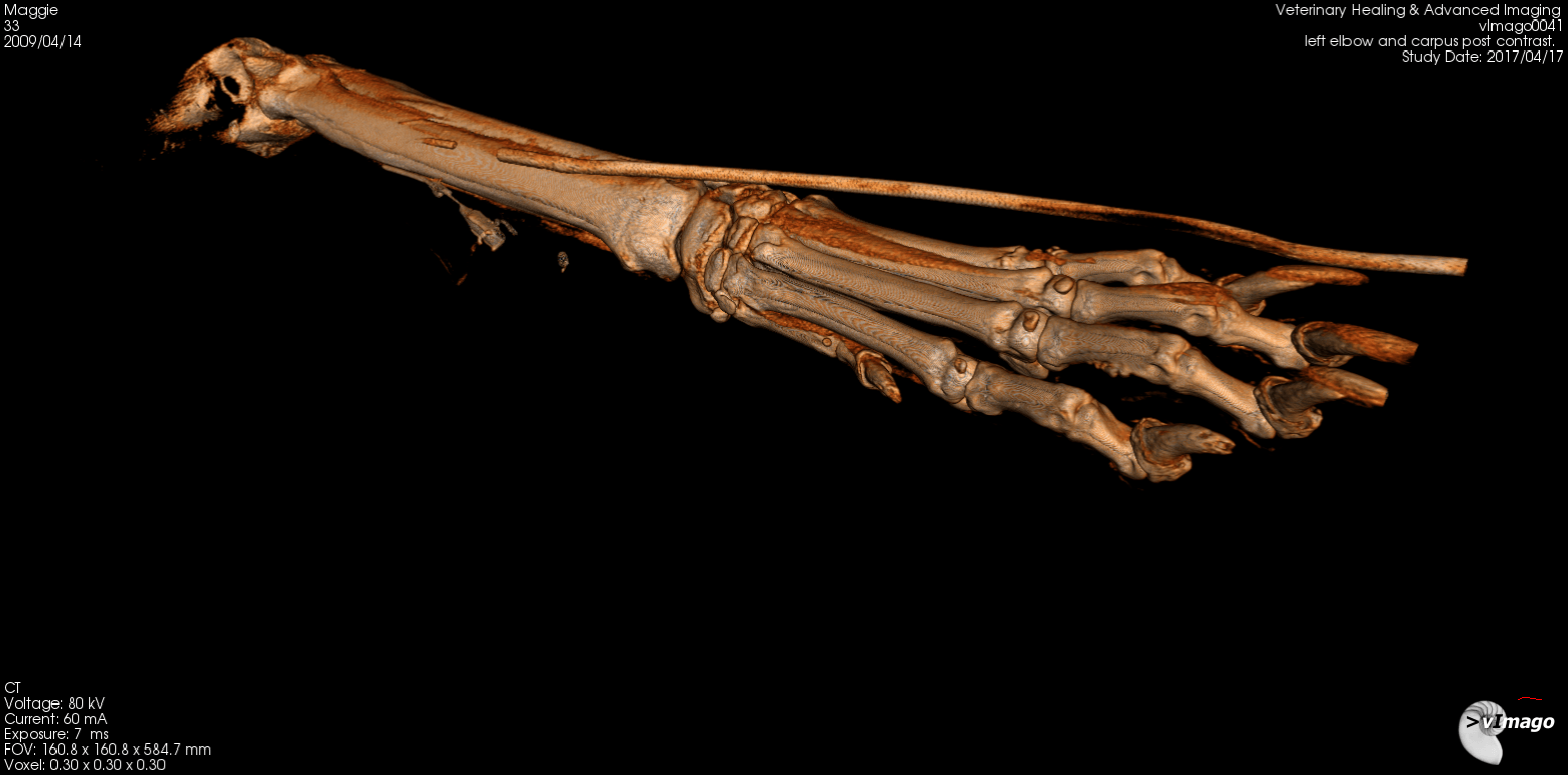 Mineralized Flexor tendon middle toe first phalanx